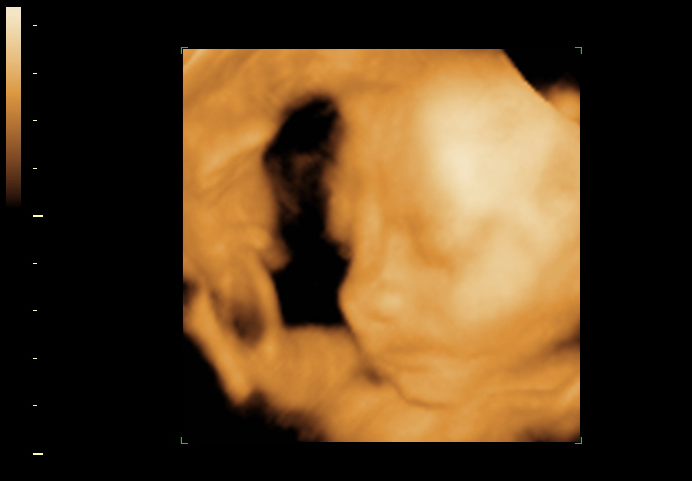 3D ultrasound image at 29 weeks